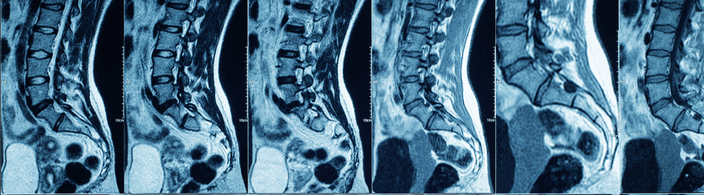 MRI van de wervelkolom