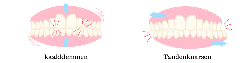 verschil kaakklemmen en tandenknarsen